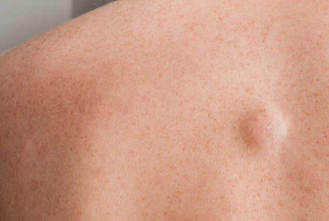 粉瘤ができている肌