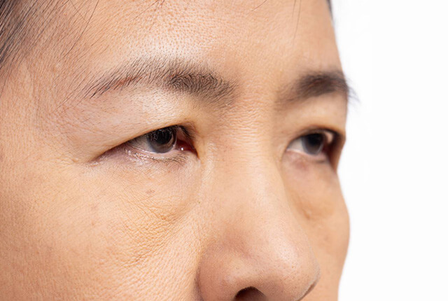眼瞼下垂症になっている女性
